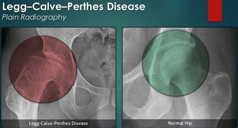 Legg Calve Perthes Disease .